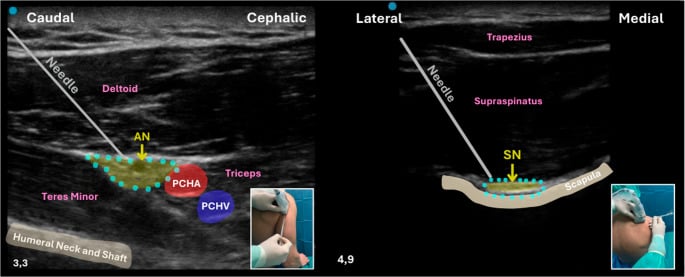 Posterior ultrasound-guided axillary nerve block beside the PCHA