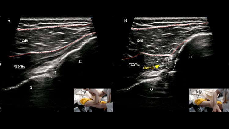 Dynamic ultrasound of abnormal teres minor contraction