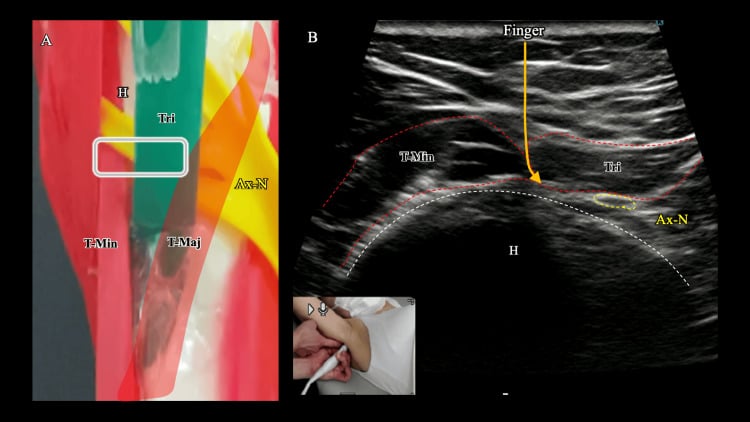 Schematic and ultrasound anatomy of the quadrilateral space