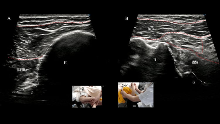 Dynamic ultrasound after rotator-cuff motor retraining