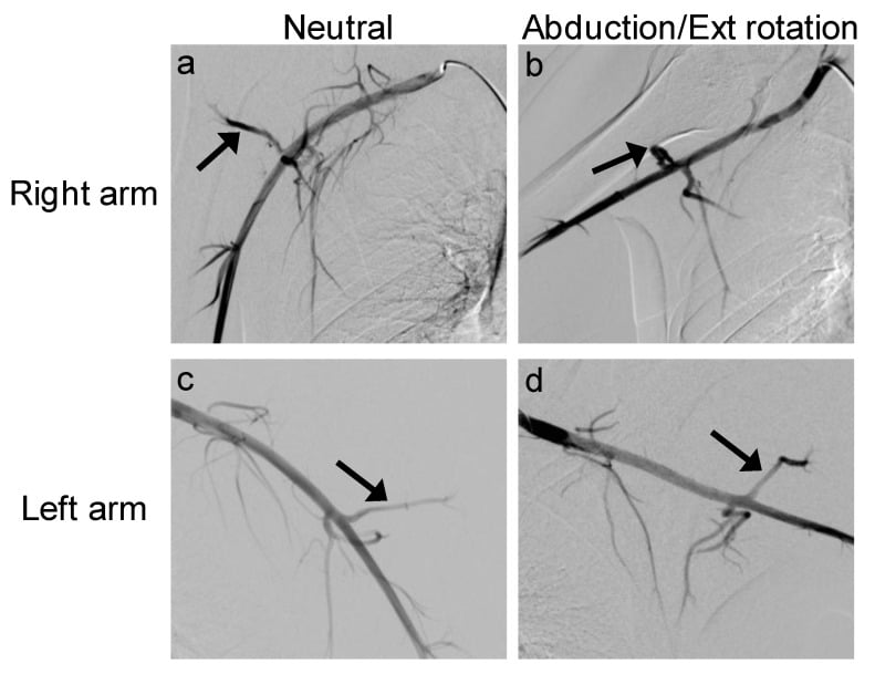 Dynamic angiography of the PCHA in neutral and provocative positions