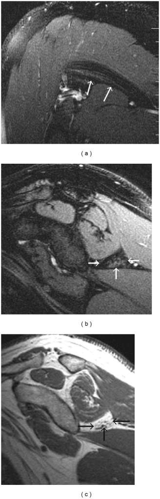 Multi-panel shoulder MRI in a patient with quadrilateral space syndrome
