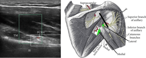 Ultrasound of the quadrilateral space with posterior circumflex humeral artery and an anatomical schematic