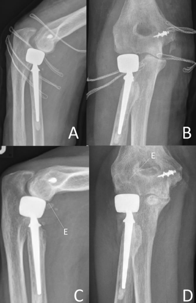 Serial radiographs showing bipolar radial head overlengthening with subluxation (A, B) and capitellar erosion labelled E a year later (C, D)