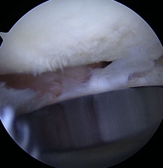 Arthroscopic view of fibrillated capitellar cartilage above the metal surface of an overlengthened radial head prosthesis