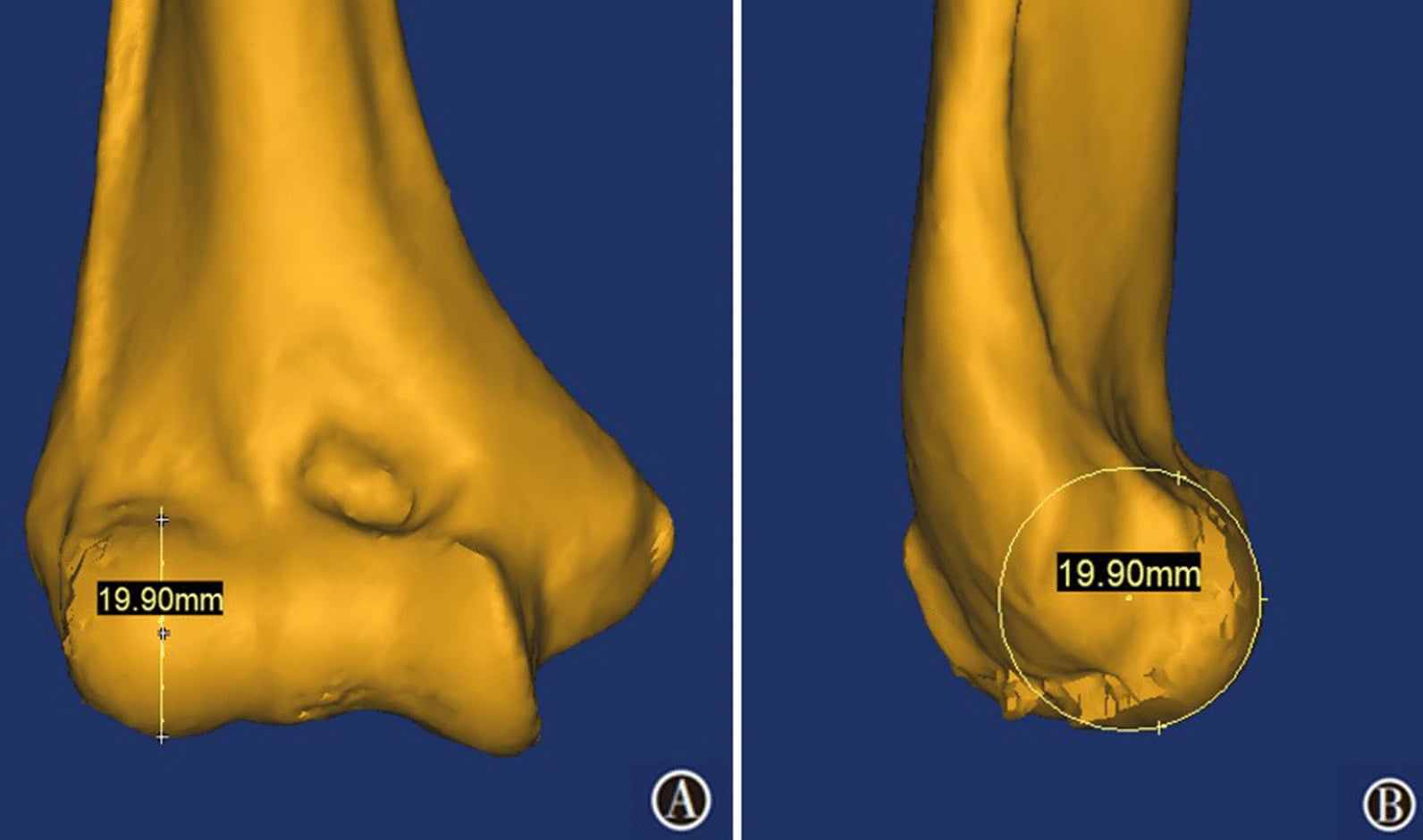 Three-dimensional CT measurement of lateral capitellar diameter for radial head prosthesis sizing