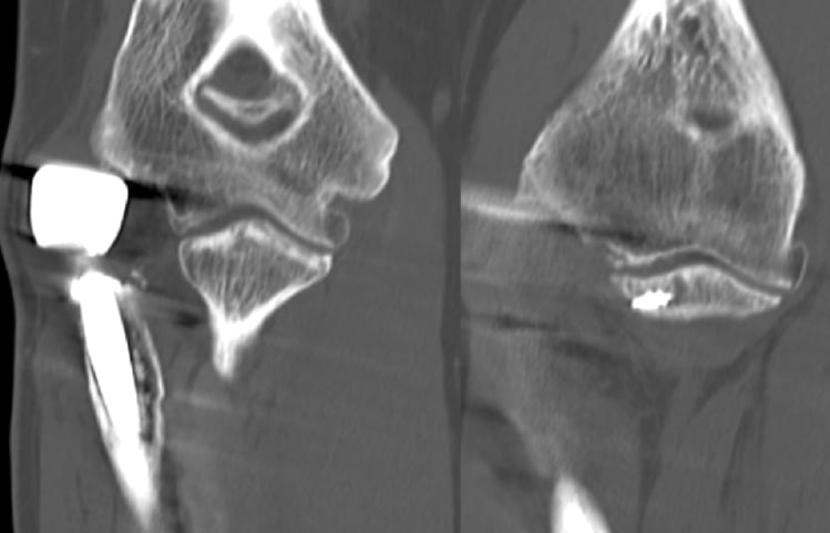 Two CT images of an elbow with a radial head prosthesis in chronic Essex-Lopresti instability, from a case of capitellar bone loss
