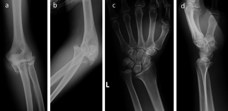 Elbow radiographs a and b of a fracture-dislocation and wrist radiographs c and d showing distal radioulnar joint dislocation