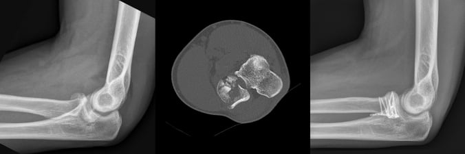 Preoperative lateral elbow radiograph, axial CT of a four-part radial head fracture, and postoperative lateral radiograph after fixation