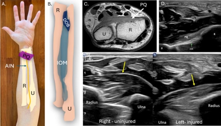 Forearm interosseous membrane and distal radioulnar joint anatomy with MRI and comparative ultrasound of uninjured right and injured left sides