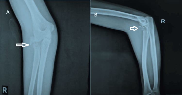 Anteroposterior and lateral radiographs, A and B, of a displaced comminuted Mason type III radial head fracture, arrows on the radial head