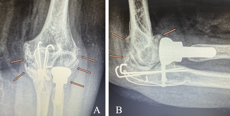 Final AP and lateral radiographs, A and B, of a radial head prosthesis and wired olecranon fracture with arrows marking heterotopic ossification