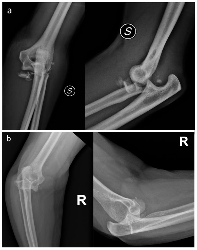 Two elbow fracture-dislocations, a and b, each on a pair of radiographs: one radial head grossly displaced and comminuted, the other retaining a small fragment