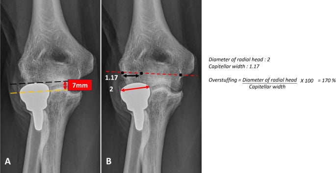 Radiographic measurements distinguishing radial head prosthesis overlengthening from overstuffing