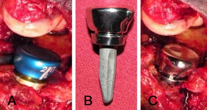 Three panels: A, a trial radial head in the elbow; B, an assembled radial head prosthesis with head and stem; C, the definitive implant in the elbow