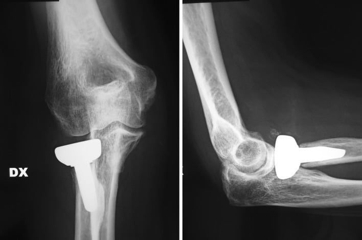 Two-panel AP and lateral radiograph showing radial head prosthesis at 2-month post-operative follow-up