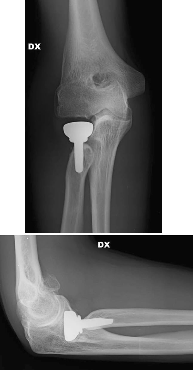 Two-panel AP and lateral radiograph showing radial head prosthesis at 5-year follow-up with stress shielding