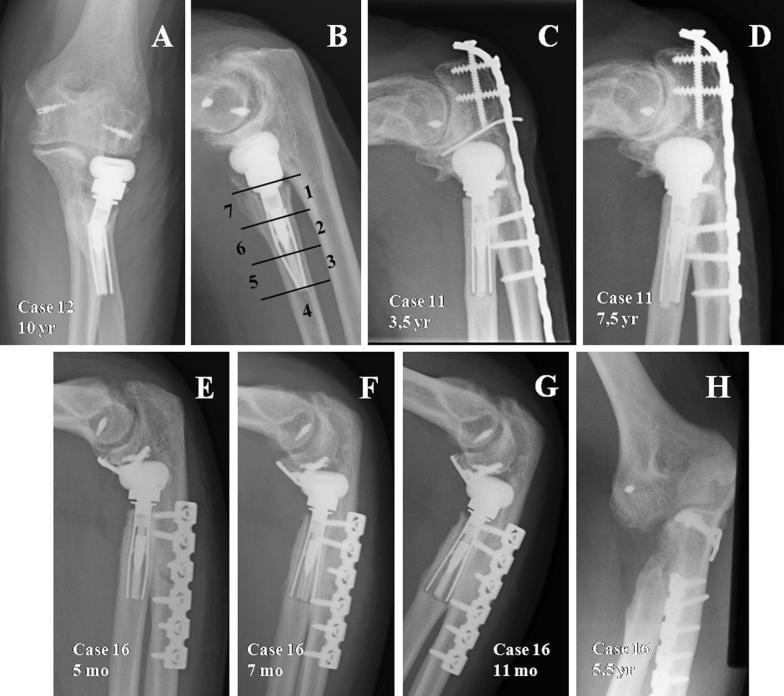 Eight-panel composite showing progressive stress shielding and stem loosening complications in radial head arthroplasty