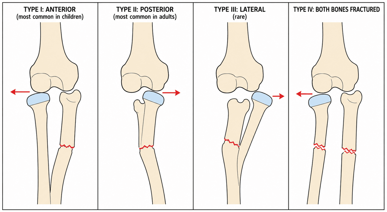 Bado classification of Monteggia fracture-dislocations showing the direction of radial head displacement for Types I-IV