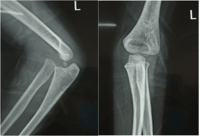 Lateral and AP radiographs of a left elbow showing a chronic anterior radial head dislocation