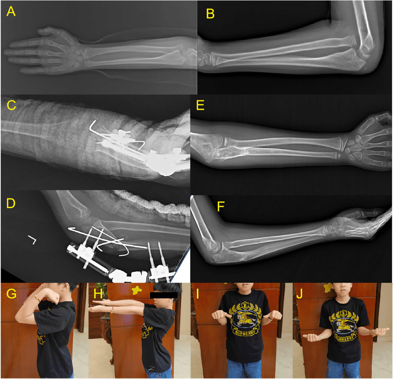 Serial radiographs and clinical photographs of a chronic Monteggia lesion treated by ulnar lengthening in an external fixator