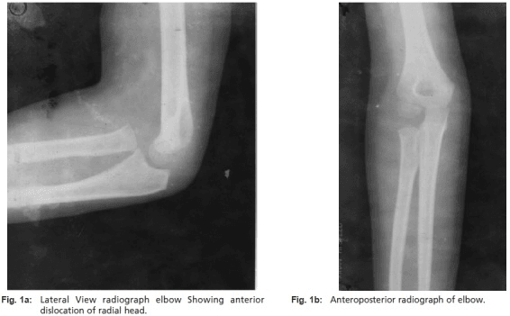 Lateral and AP elbow radiographs showing an anterior radial head dislocation without an obvious ulnar fracture