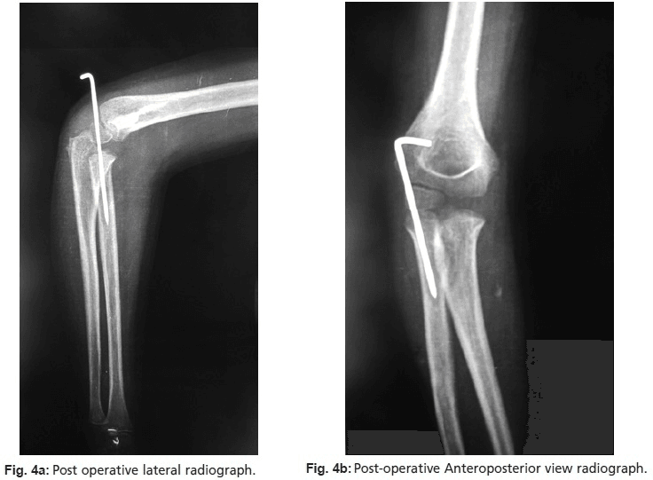 Postoperative lateral and AP elbow radiographs with a bent wire crossing the elbow after reduction of a radial head dislocation
