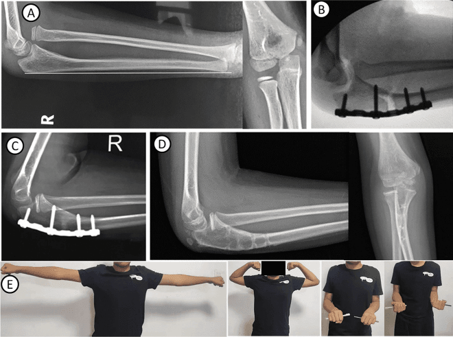 Serial radiographs and clinical photographs of a missed Bado I Monteggia lesion treated by plated ulnar osteotomy