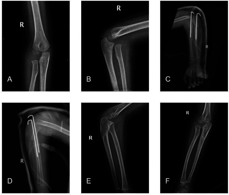 Serial elbow and forearm radiographs before and after ulnar osteotomy with wire fixation for missed Monteggia