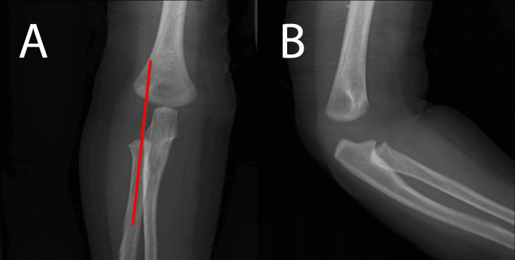 AP and lateral radiographs of an infant's elbow with a red line drawn along the proximal radius