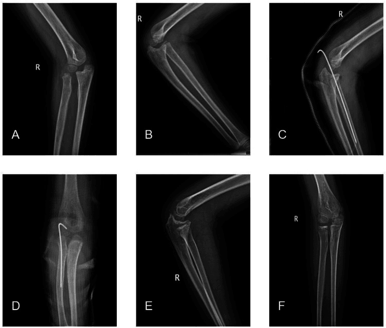 Serial elbow radiographs of open reduction of a chronic radial head dislocation held with a temporary wire