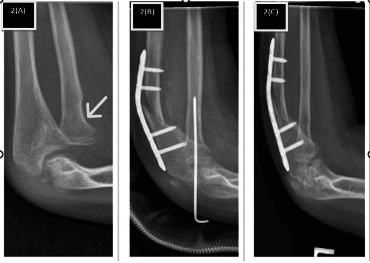 Serial lateral elbow radiographs of a chronic Monteggia lesion before and after plated ulnar osteotomy with a temporary wire