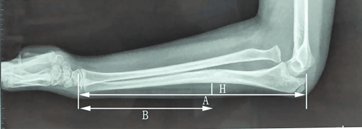 Lateral forearm radiograph with a straight line A along the ulna, maximum deviation H and distance B marked