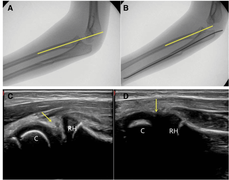 Lateral fluoroscopic images with a yellow line along the radius, and elbow ultrasound images labelled C and RH with yellow arrows