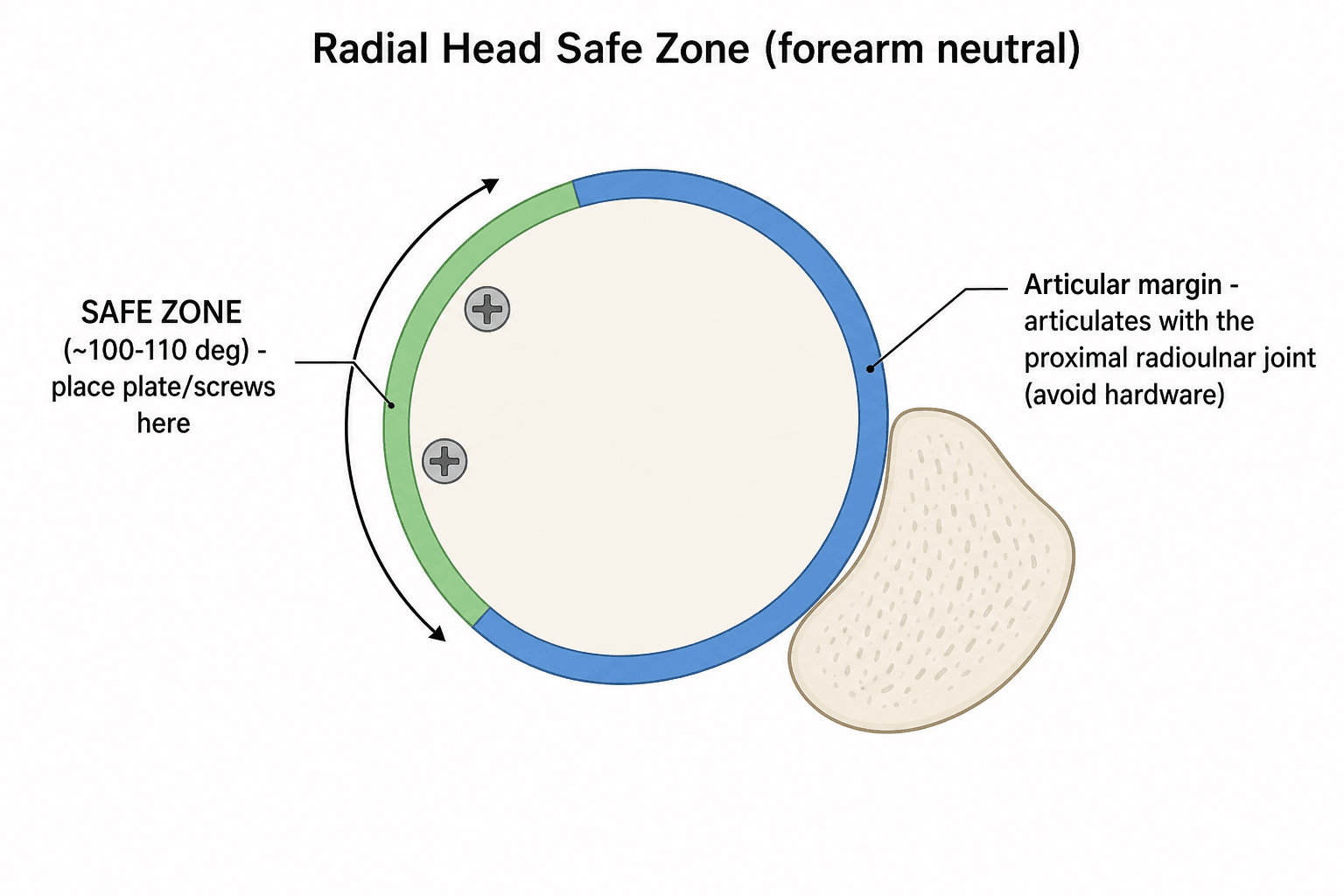 Axial schematic of the radial head showing the non-articular safe zone for hardware placement versus the articular margin facing the proximal radioulnar joint.