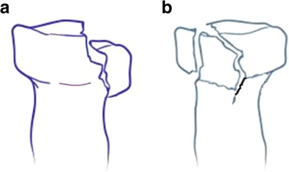 Mason type II radial head fracture classification diagram