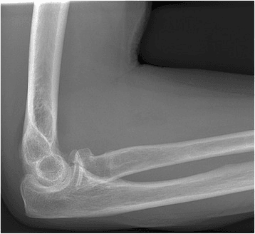 Lateral elbow radiograph showing radiocapitellar joint anatomy and the proximal radius