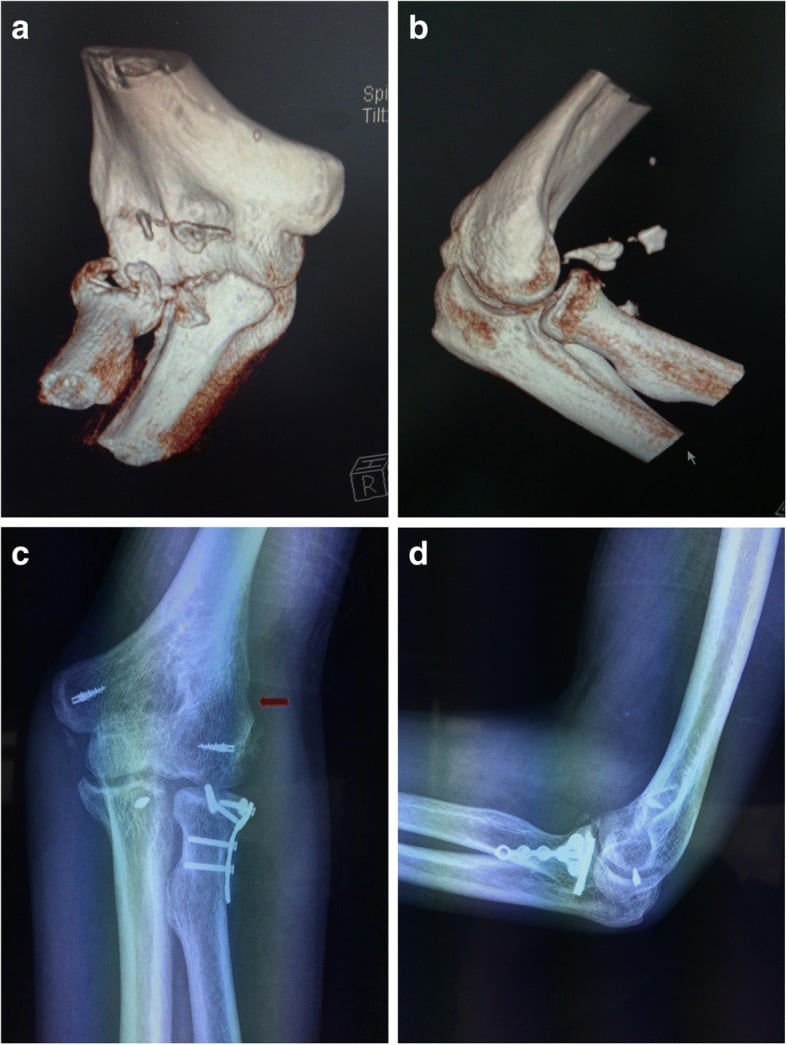 Terrible triad ORIF - preoperative CT and postoperative X-rays