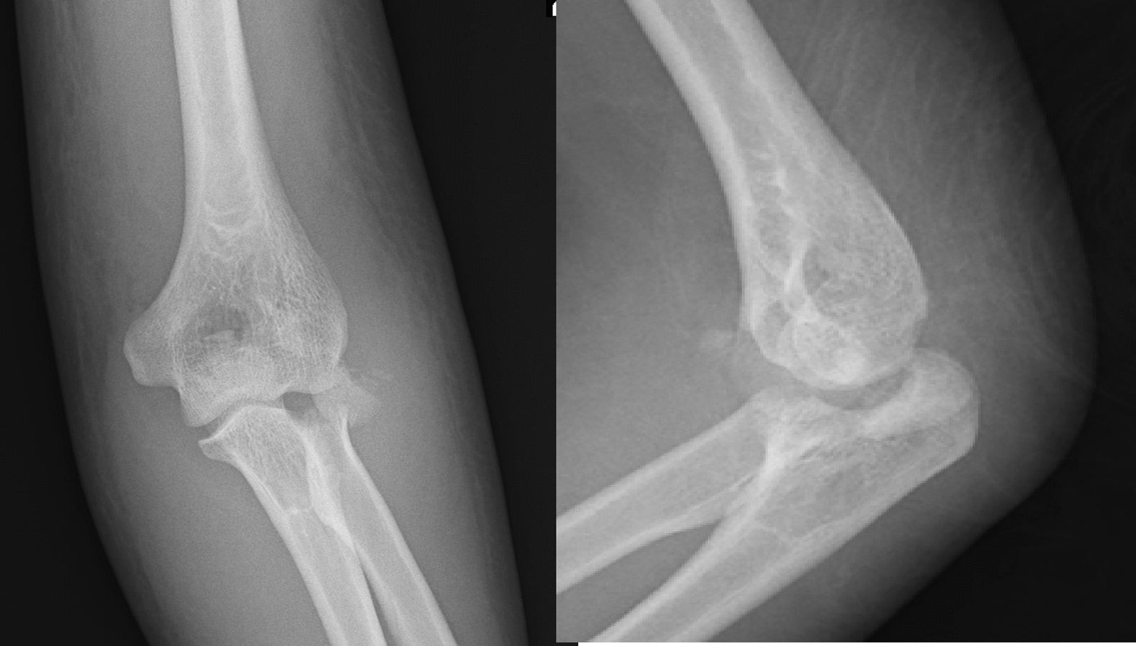 Terrible triad elbow injury X-rays showing radial head and coronoid fractures
