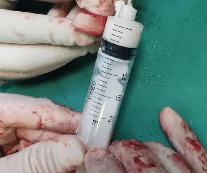 Intraoperative preparation of radial head spacer