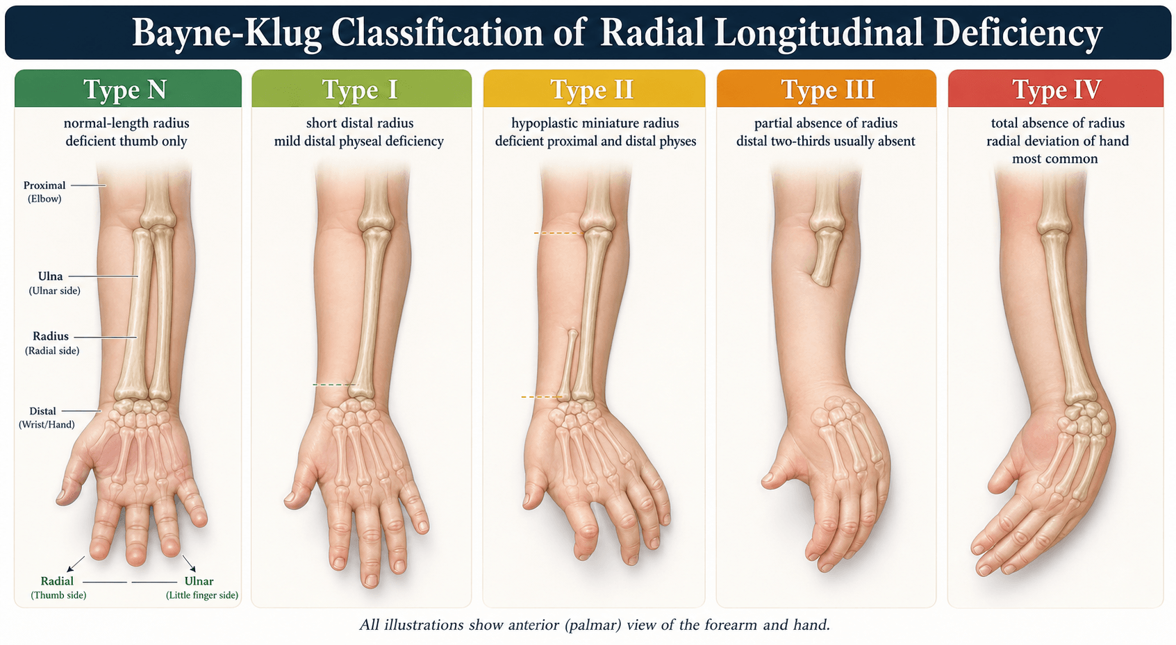 Bayne-Klug classification of radial longitudinal deficiency