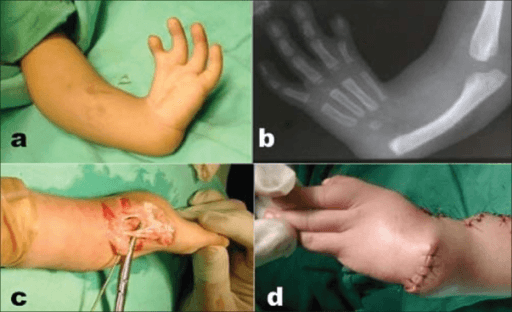 Grade IV radial club hand before centralisation, radiograph, displaced superficial median nerve at surgery and immediate correction
