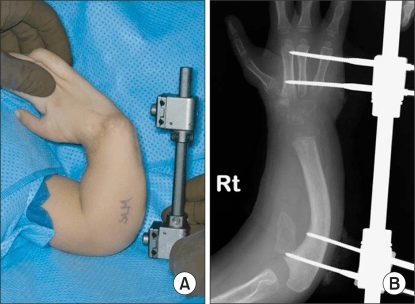 Clinical and radiographic example of severe radial club hand treated with external distraction