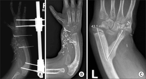 Radiographs showing fixation after radial longitudinal deficiency reconstruction