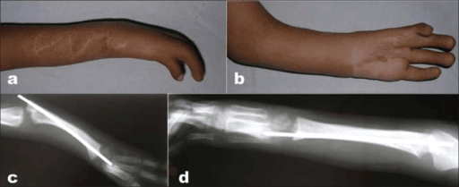 Radial club hand clinical and radiographic alignment maintained at one-year follow-up
