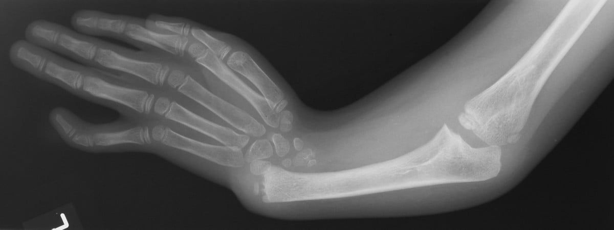 AP radiograph of a child's forearm showing a completely absent radius with the hand deviated radially.