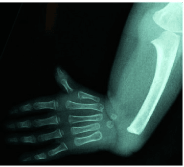 Radiograph showing absent radius with thumb present