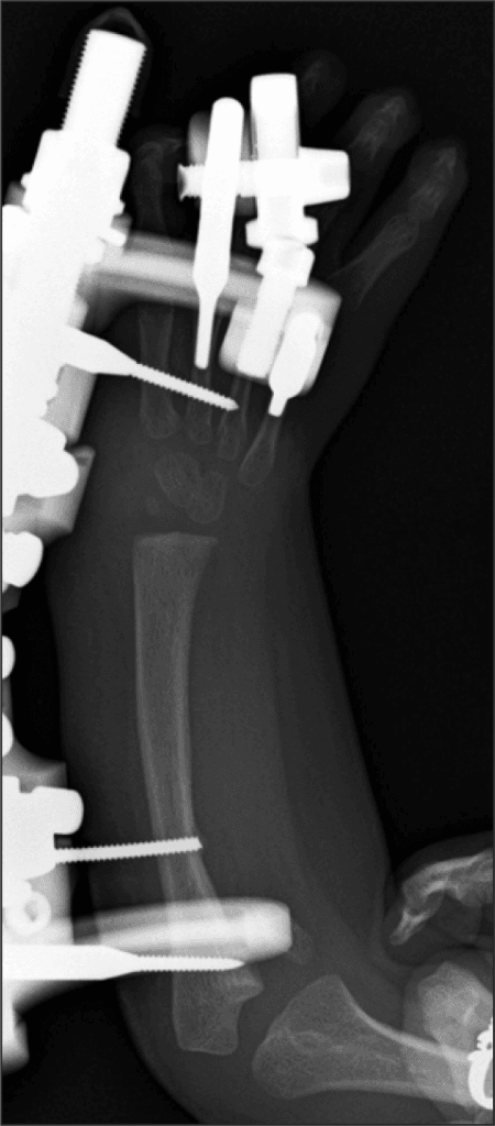 Radiographic planning during distraction for radial longitudinal deficiency