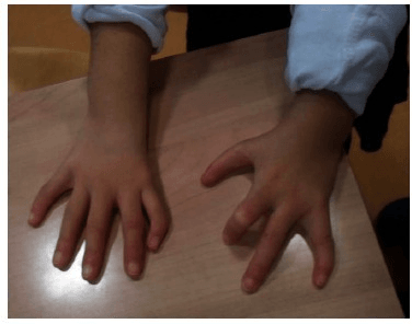 Clinical photograph showing radial ray thumb deficiency pattern and pollicisation
