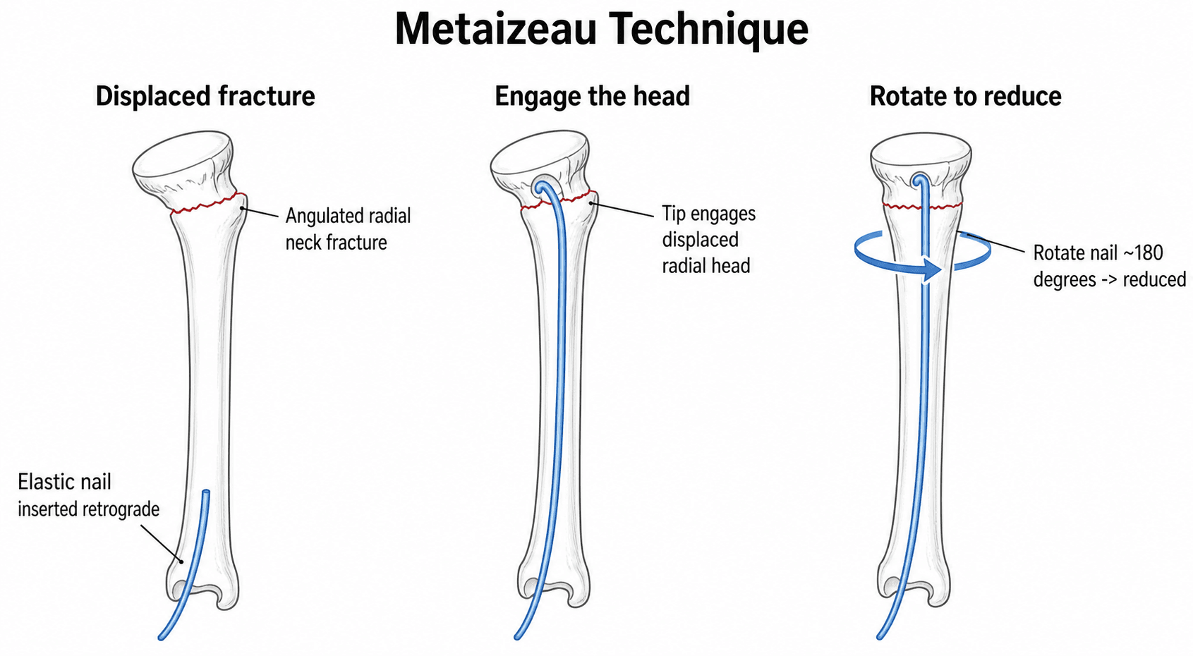 Three-panel diagram of the Metaizeau technique: a retrograde elastic nail is advanced up the radius to engage the displaced radial head, then rotated about 180 degrees to reduce the fracture.